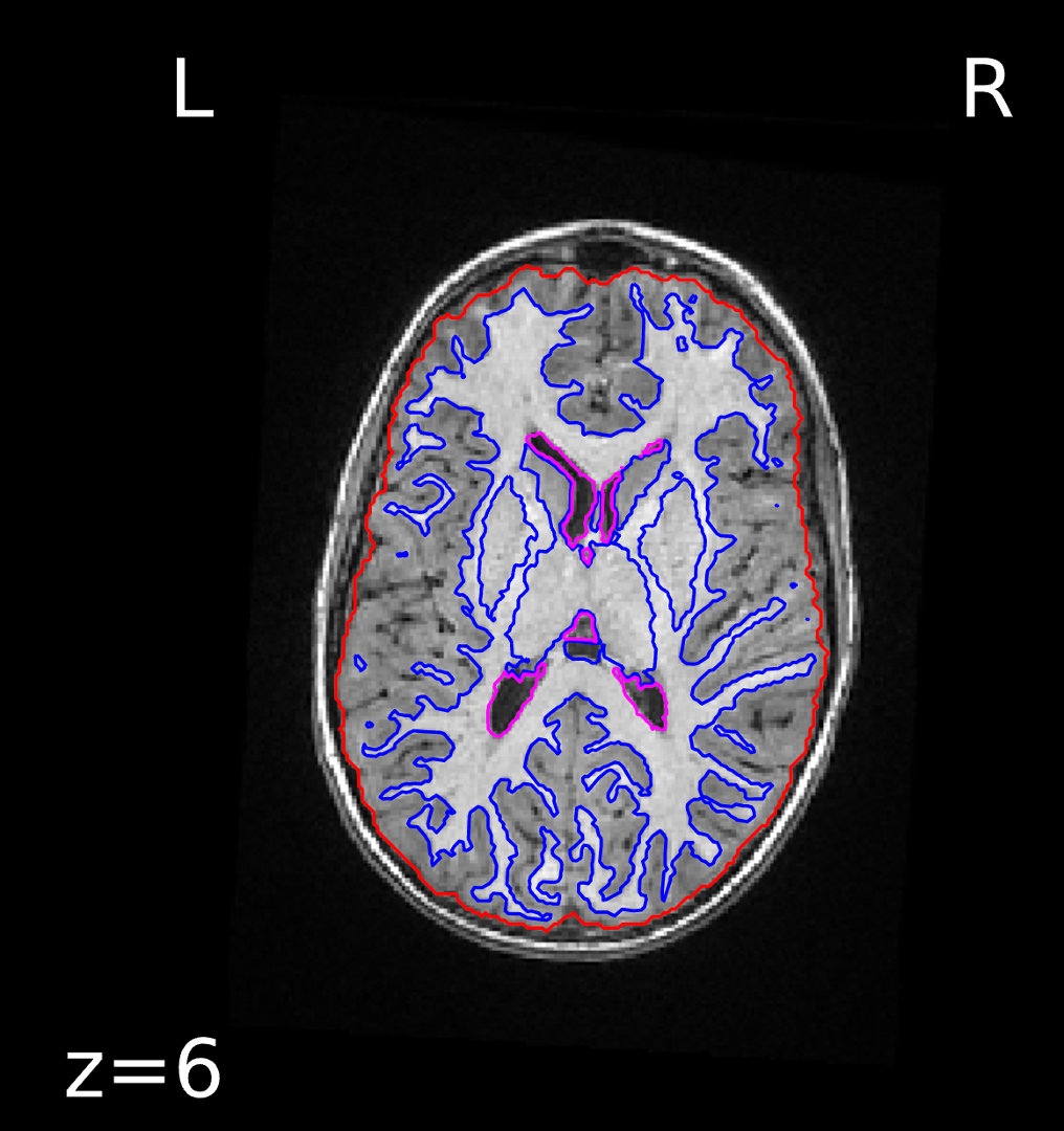 Brain mask and tissue segmentation for subject 3, child without ADHD